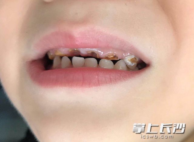 酷爱喝可乐的7岁男孩喆喆（化名）烂掉了17颗牙齿。