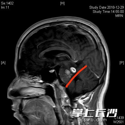 患者头部核磁共振影像。红线上方的白色部位为寄生虫感染。