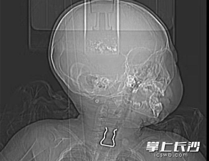 X光片上可以清楚地看到金属异物位于食道入口处。 湖南省人民医院 供图。