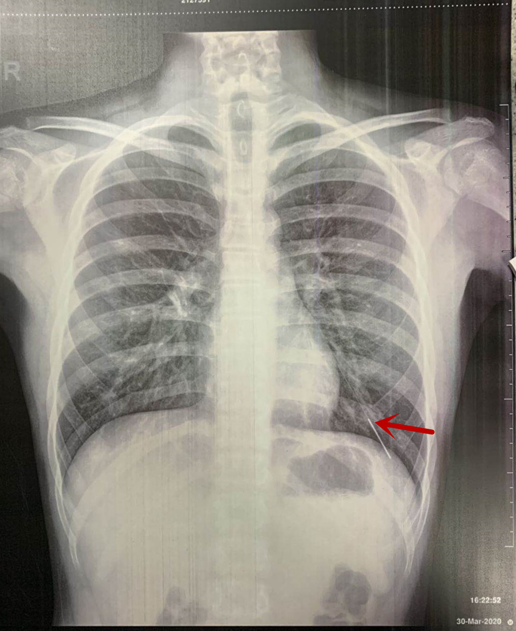 CT显示，针灸针扎入小迪左肺。长沙晚报通讯员 吴靖 黄若冰 供图