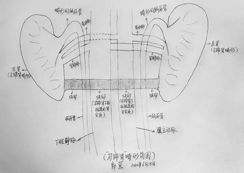 马蹄肾解剖简图。郭玺 绘