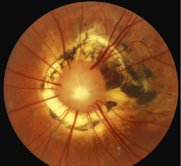 从眼底照相上看，孩子的视网膜宛如一朵盛开的“牵牛花”。 资料图片