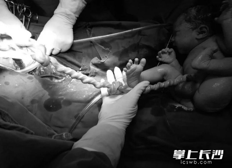 宝宝出来后，脐带不仅打了两个真结，且呈高度扭转状态。医院 供图