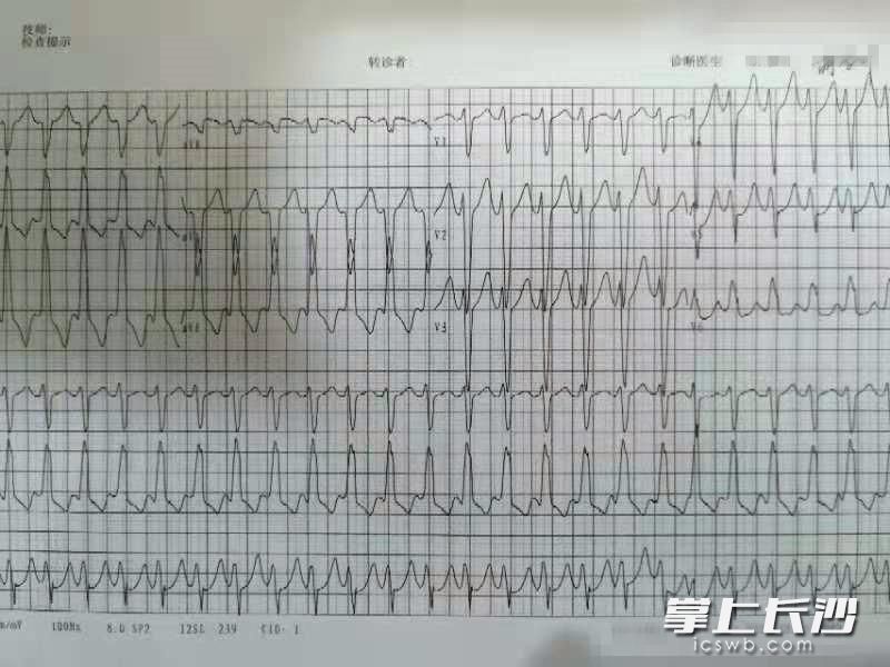 韩女士的心电图显示室性心律失常。均为长沙晚报通讯员 吴威 供图