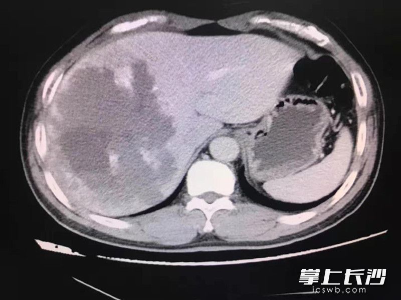 患者进行CT检查发现“肝脏占位，肝血管瘤”。由医院供图